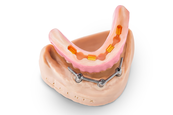 AccuFrame Overdenture 6